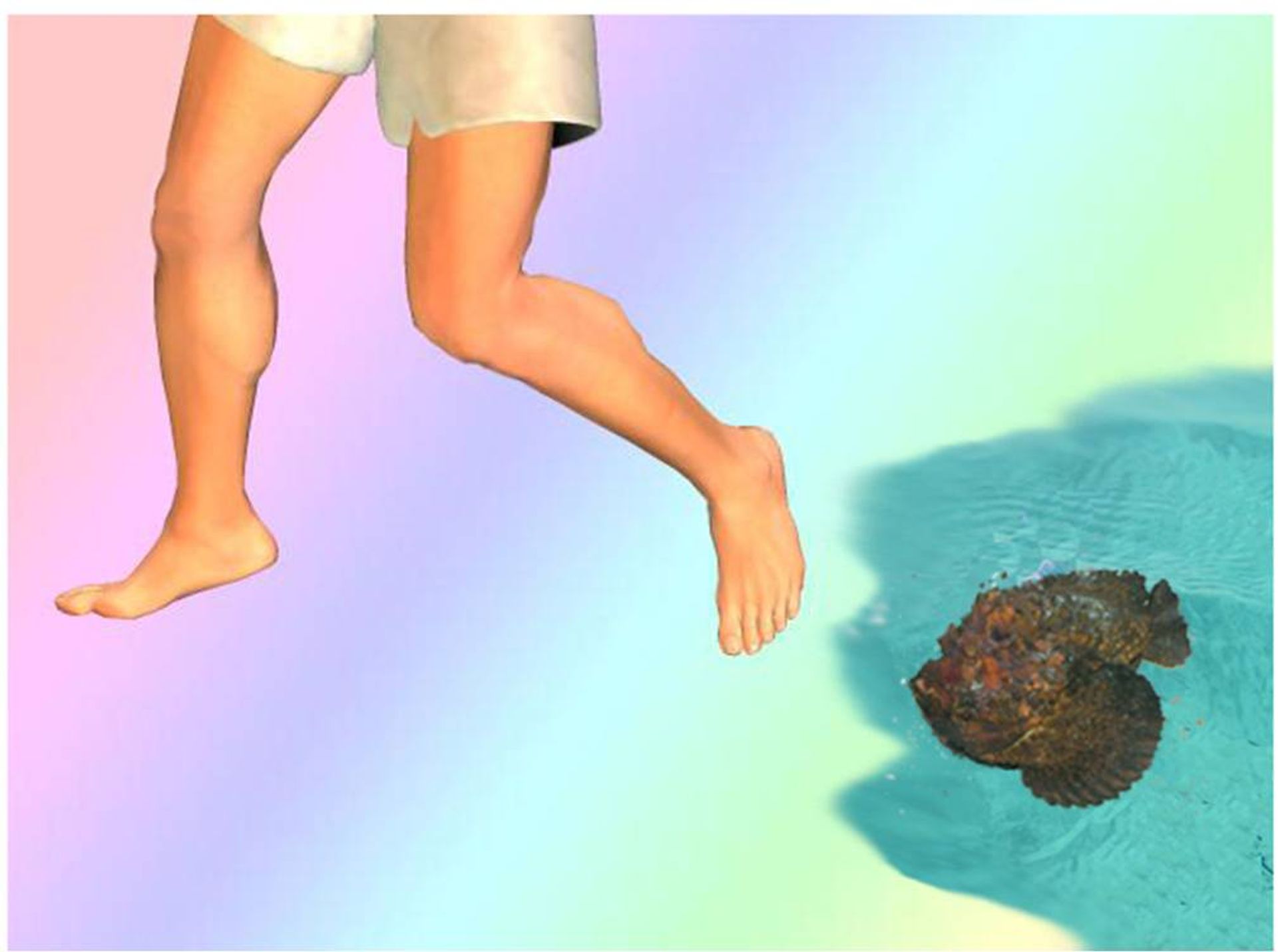 post_علاج التسمم من لسعات الأسماك